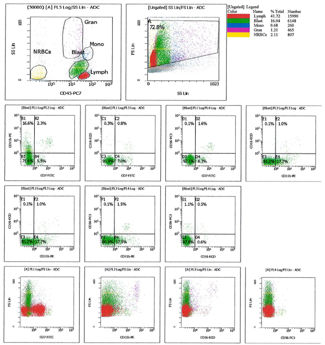 Flow cytometry of the FNA from pelvic lymph node showing that blasts have dim expression of CD11b but no expression of CD56 or CD16